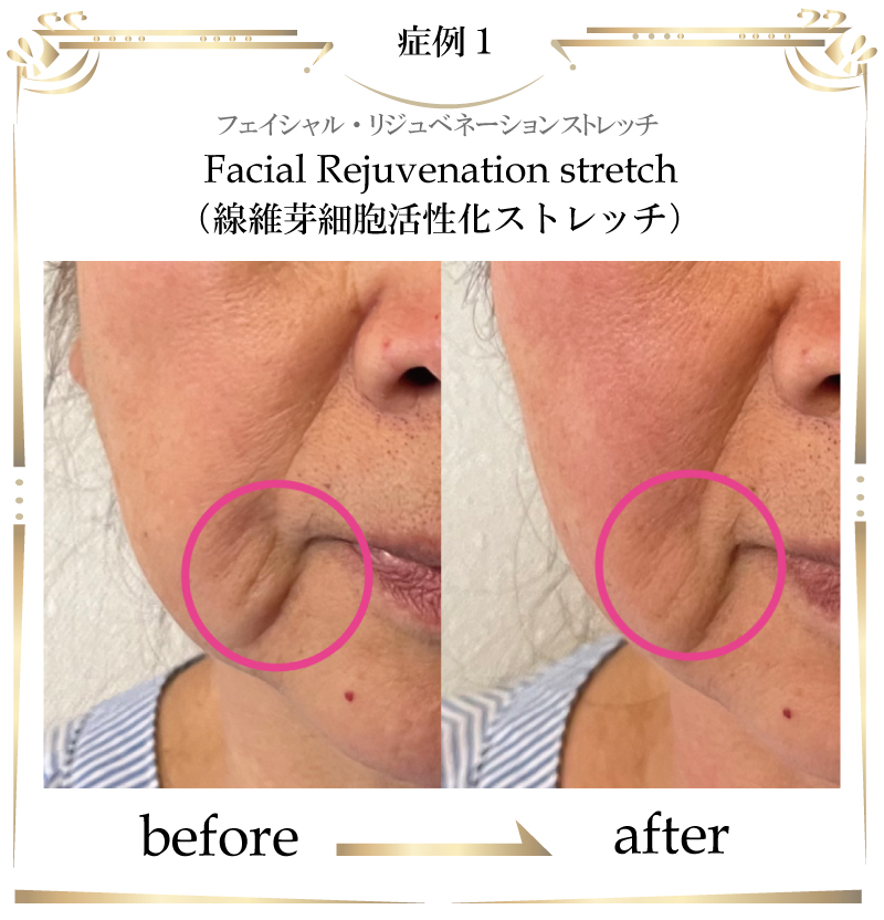 線維芽細胞,フェイシャル,大阪,線維芽細胞活性化ストレッチ