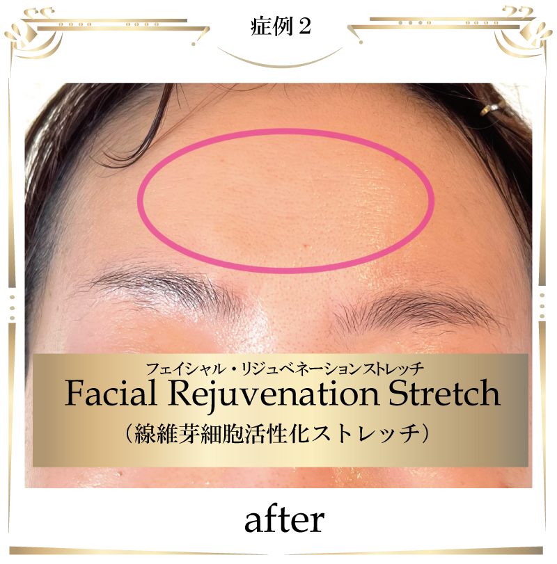 線維芽細胞,フェイシャル,大阪,線維芽細胞活性化ストレッチ