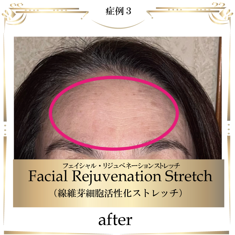線維芽細胞,フェイシャル,大阪,若返り