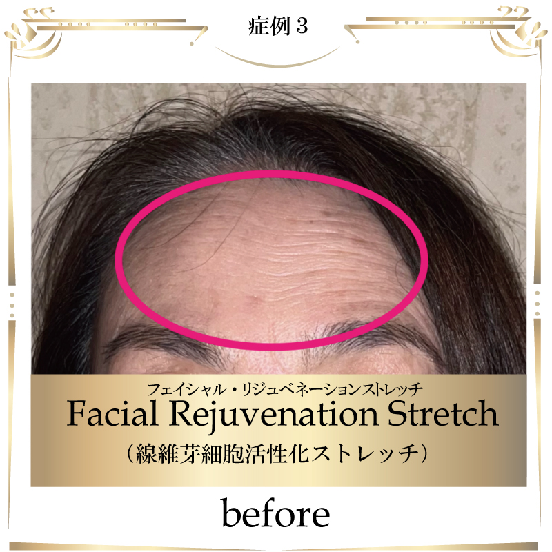 線維芽細胞,フェイシャル,大阪,若返り