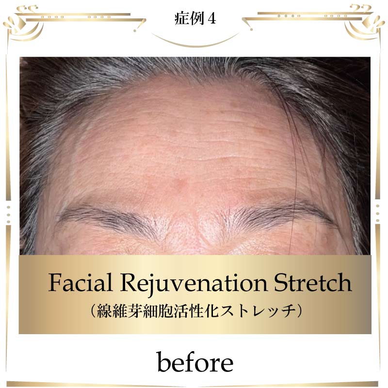 線維芽細胞,フェイシャル,大阪,線維芽細胞活性化ストレッチ