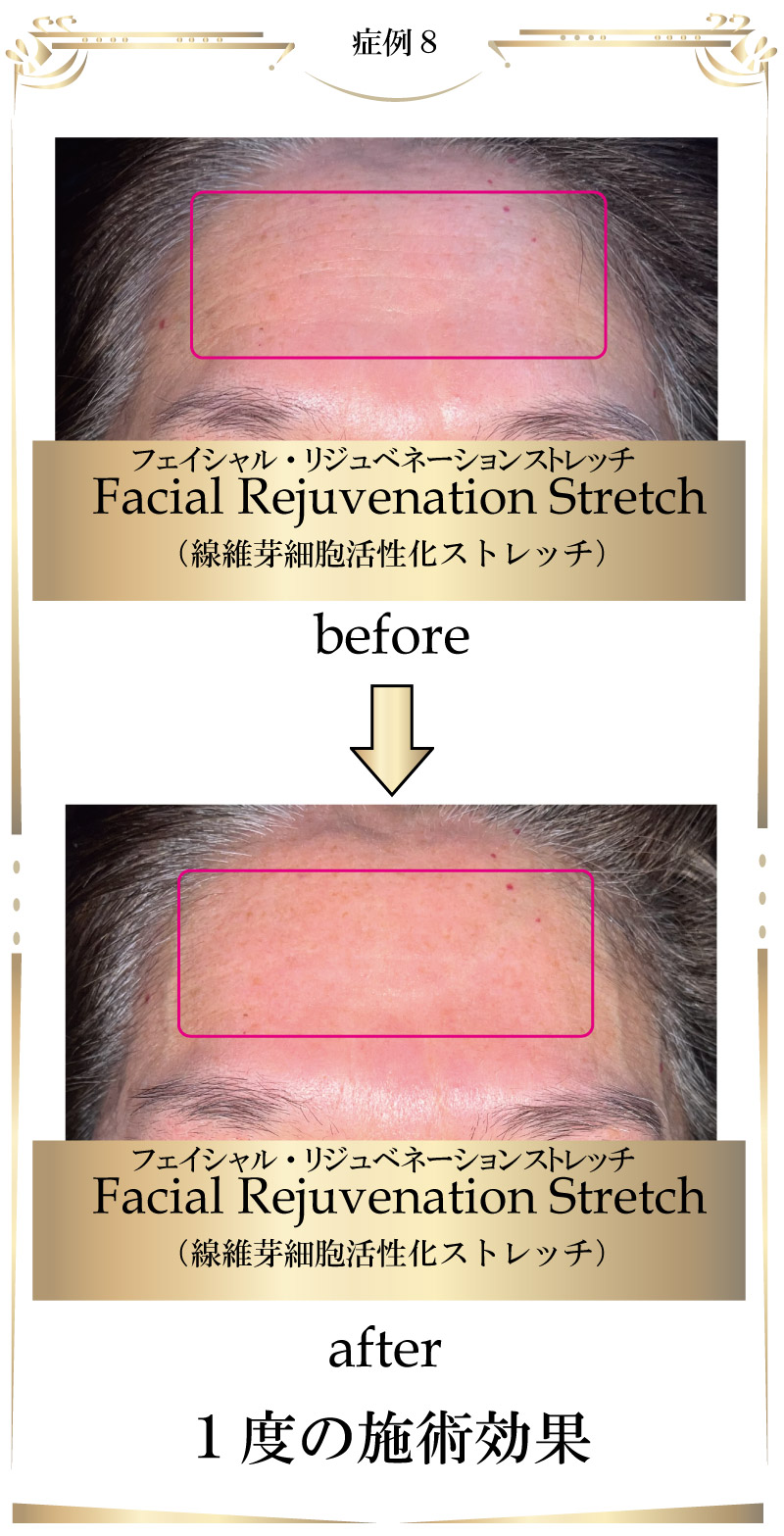 若返り,フェイシャルリジュベネーションストレッチ,フェイシャル,大阪