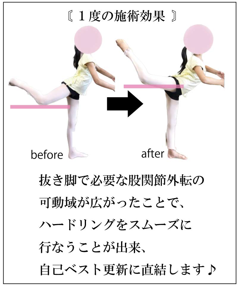 ハードル走力,足が速くなる,整体,ストレッチ,柔軟性